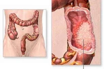 Kiểm tra sau phẫu thuật ngăn ngừa ung thư tái phát