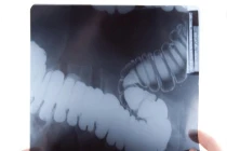 Thử nghiệm đơn giản phát hiện hầu hết ung thư ruột