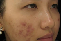 Chỉ một mẹo nhỏ này, sẹo thâm lâu năm cứng đầu đến mấy cũng phải đầu hàng 