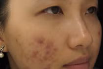 Chỉ một mẹo nhỏ này, sẹo thâm lâu năm cứng đầu đến mấy cũng phải đầu hàng 