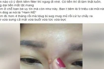 Hotgirl bị chảy dịch mủ sau tiêm filler nâng mũi 
