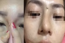 Nhận trái đắng từ trào lưu nâng mũi bằng tiêm filler