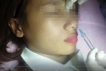 Rùng mình kim chui vào mắt, lúm đồng tiền thành ổ áp-xe sau "dao kéo"