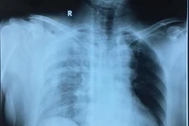 Phẫu thuật thành công bệnh nhân đa chấn thương nhóm máu hiếm O Rh(-)