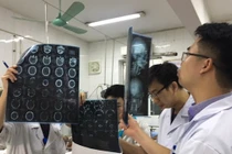 Uống an cung ngừa đột quỵ, một bệnh nhân xuất huyết toàn thân