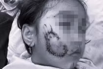 Bị chó cắn, bé gái 5 tuổi ở Quảng Bình phải khâu 50 mũi