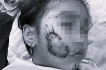 Bị chó cắn, bé gái 5 tuổi ở Quảng Bình phải khâu 50 mũi