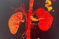 Quảng Bình: Cứu sống nam sinh bị đâm thủng thận “thập tử nhất sinh“