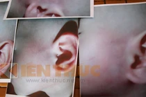 Hà Nội: nghi vấn bé 13 tháng tuổi bị bảo mẫu đánh tím mặt