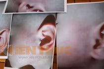 Hà Nội: nghi vấn bé 13 tháng tuổi bị bảo mẫu đánh tím mặt