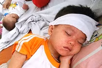 9 khuyến cáo nên đọc gấp để phòng chống bệnh sởi