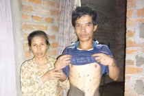 Chàng trai "da trâu” có tinh hoàn "khủng” ở Bình Định