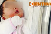 Bệnh EB: Nếu trẻ nhiễm trùng nguy cơ tử vong rất cao