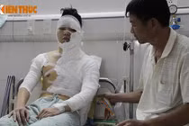 Một sinh viên Hà Nội bị tạt axit lúc nửa đêm