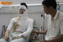 Một sinh viên Hà Nội bị tạt axit lúc nửa đêm