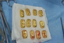 Doanh nhân nuốt 12 thỏi vàng vào bụng để buôn lậu