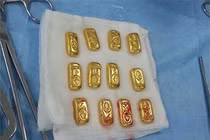 Doanh nhân nuốt 12 thỏi vàng vào bụng để buôn lậu