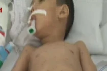 Sởi chưa dứt, bệnh tay chân miệng và thủy đậu bùng phát