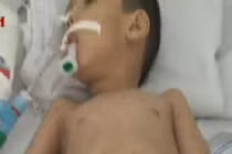 Sởi chưa dứt, bệnh tay chân miệng và thủy đậu bùng phát