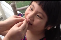 Cười ngoác miệng với cách nhổ răng huyền thoại