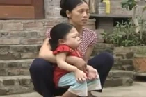 Bệnh lạ khiến người giống ếch ở Hà Nội