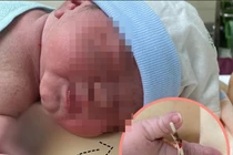 Hy hữu: Bé gái chào đời cùng... vòng tránh thai của mẹ