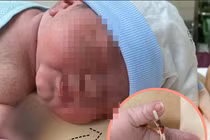 Hy hữu: Bé gái chào đời cùng... vòng tránh thai của mẹ