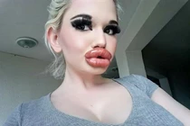 Cận cảnh “đôi môi lớn nhất thế giới” sau hơn 30 lần tiêm filler