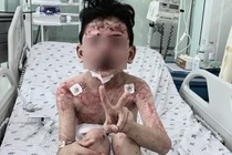 Bé trai mắc bệnh lạ nguy hiểm sau 2 ngày ăn cua