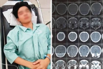 Vụ nam sinh bị hành hung nứt sọ não: Nghi do mâu thuẫn tình cảm