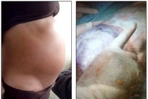 Kinh hoàng u nang buồng trứng nặng 10kg