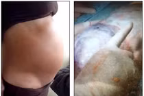 Kinh hoàng u nang buồng trứng nặng 10kg