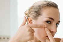 Truy nguyên nhân gây mụn trứng cá ở tuổi trưởng thành
