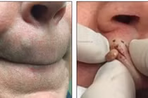 Kinh khủng mụn trứng cá to hơn con giòi