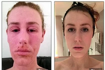 Mỹ nữ bị biến dạng toàn thân vì dùng kem trị eczema