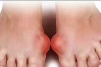 Nhìn xuống bàn chân thấy 6 dấu hiệu này cần đi khám ngay, đừng để lâu mà hối không kịp