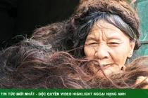 Người phụ nữ có mái tóc kì dị: Kết thành nhiều mảng, cứ cắt là đổ bệnh