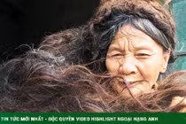 Người phụ nữ có mái tóc kì dị: Kết thành nhiều mảng, cứ cắt là đổ bệnh