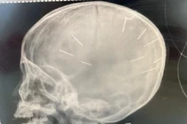 Bé gái bị đinh găm trong đầu chưa được phẫu thuật