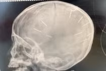 Bé gái bị đinh găm trong đầu chưa được phẫu thuật