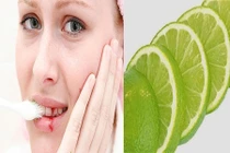Chữa chảy máu chân răng tại nhà bằng bài thuốc đơn giản 