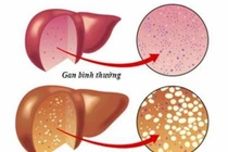 Gan nhiễm mỡ - kẻ giết người thầm lặng, cách gì phòng ngừa