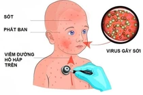 Bệnh sởi - những điều bố mẹ cần biết để phòng trong mùa dịch