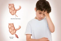 Nhiều trẻ viêm phúc mạc do vỡ ruột thừa mới đến viện