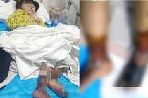 Bé gái 4 tuổi bị "mẹ kế" rót nước sôi, nguy cơ bỏ hai chân