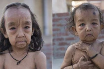 Bé gái mang khuôn mặt già hơn cha mẹ vì nguyên nhân đau lòng