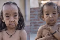 Bé gái mang khuôn mặt già hơn cha mẹ vì nguyên nhân đau lòng
