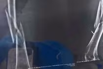 Giáo viên yoga bẻ gãy xương đùi của học viên trong lúc dạy 