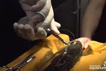 Xem phẫu thuật thay mắt cá bị đục thủy tinh thể