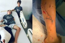 Chơi trốn tìm, cậu bé bị cá sấu "phục kích", suýt ngoạm mất chân